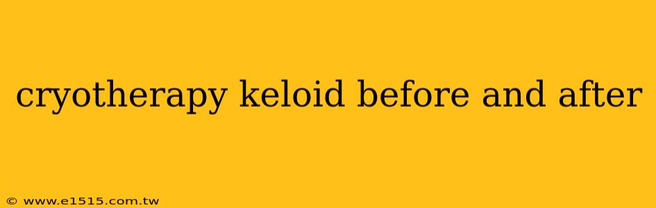 cryotherapy keloid before and after