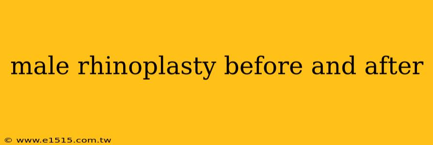 male rhinoplasty before and after