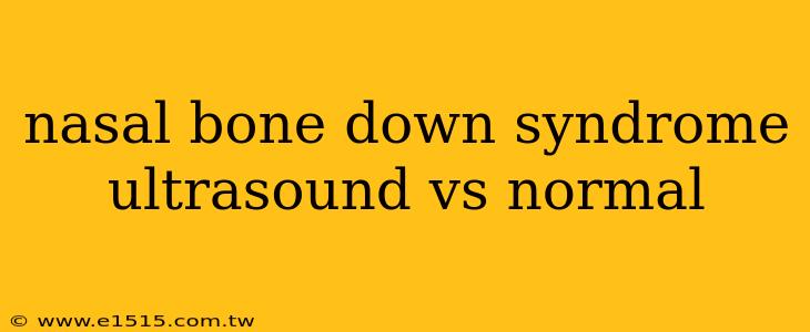 nasal bone down syndrome ultrasound vs normal
